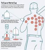 Does Cupping Help with Sleep?
