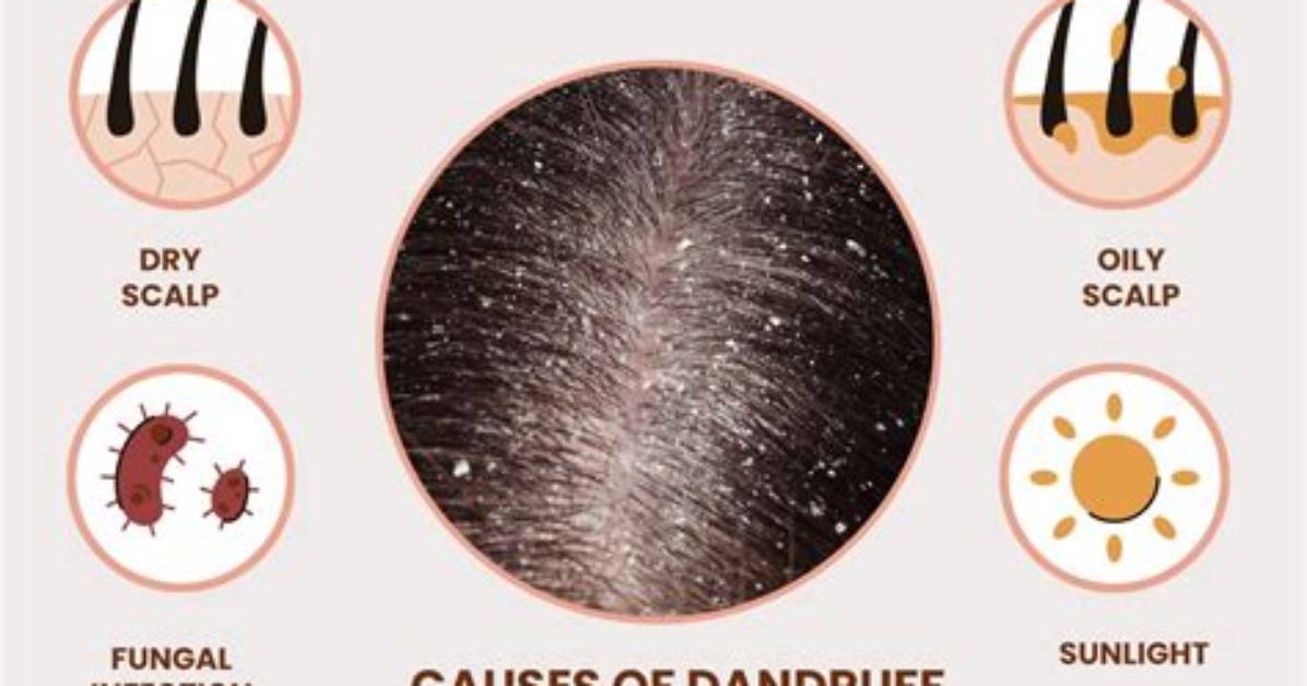 Does Dandruff Cause Hairloss?