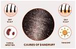 Does Dandruff Cause Hairloss?