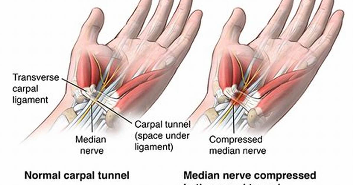 Does Driving Make Carpal Tunnel Worse?