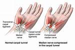 Does Driving Make Carpal Tunnel Worse?