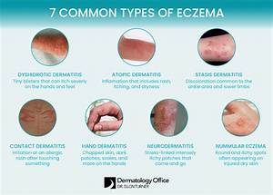 Does Eczema Make You More Likely to Get Sick?