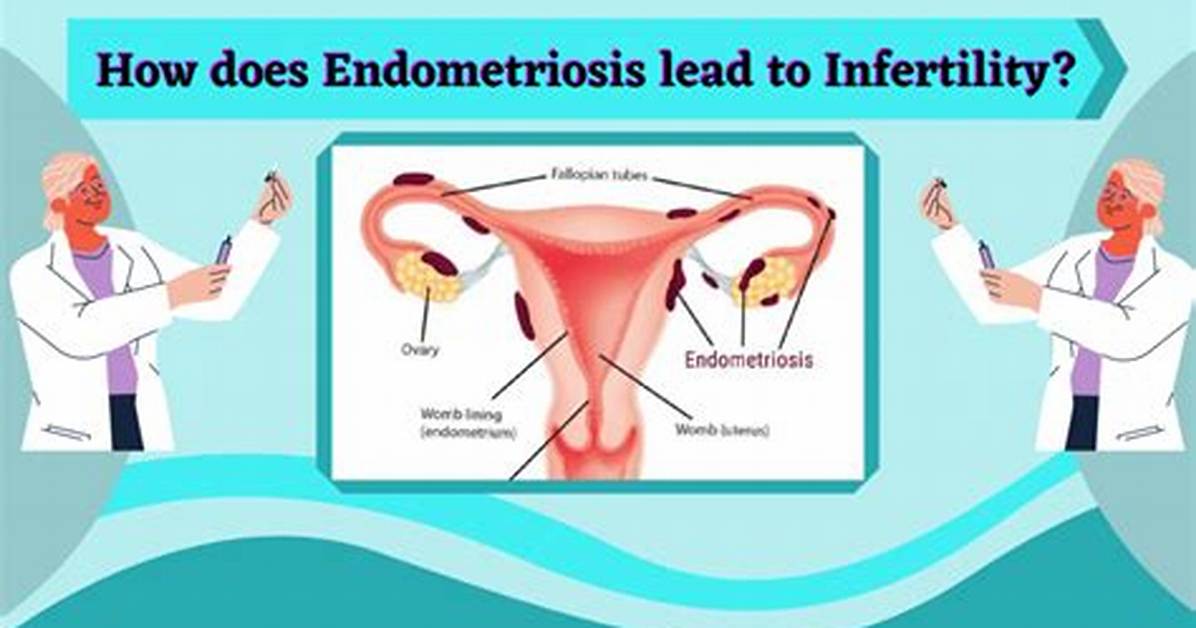 Does Endometriosis Always Cause Infertility?