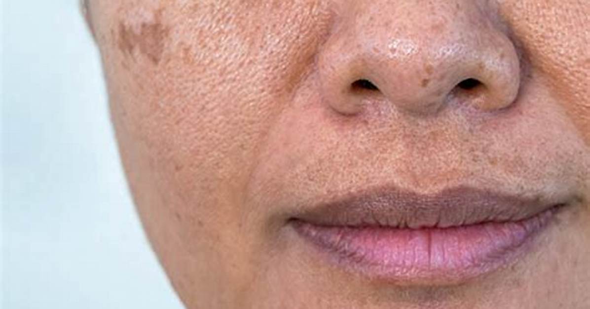 Does Freckles Make You Look Younger?