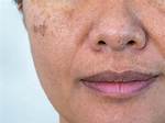 Does Freckles Make You Look Younger?