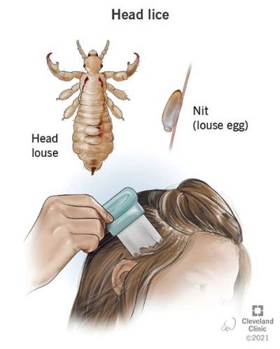 Does Head and Shoulders Remove Lice?
