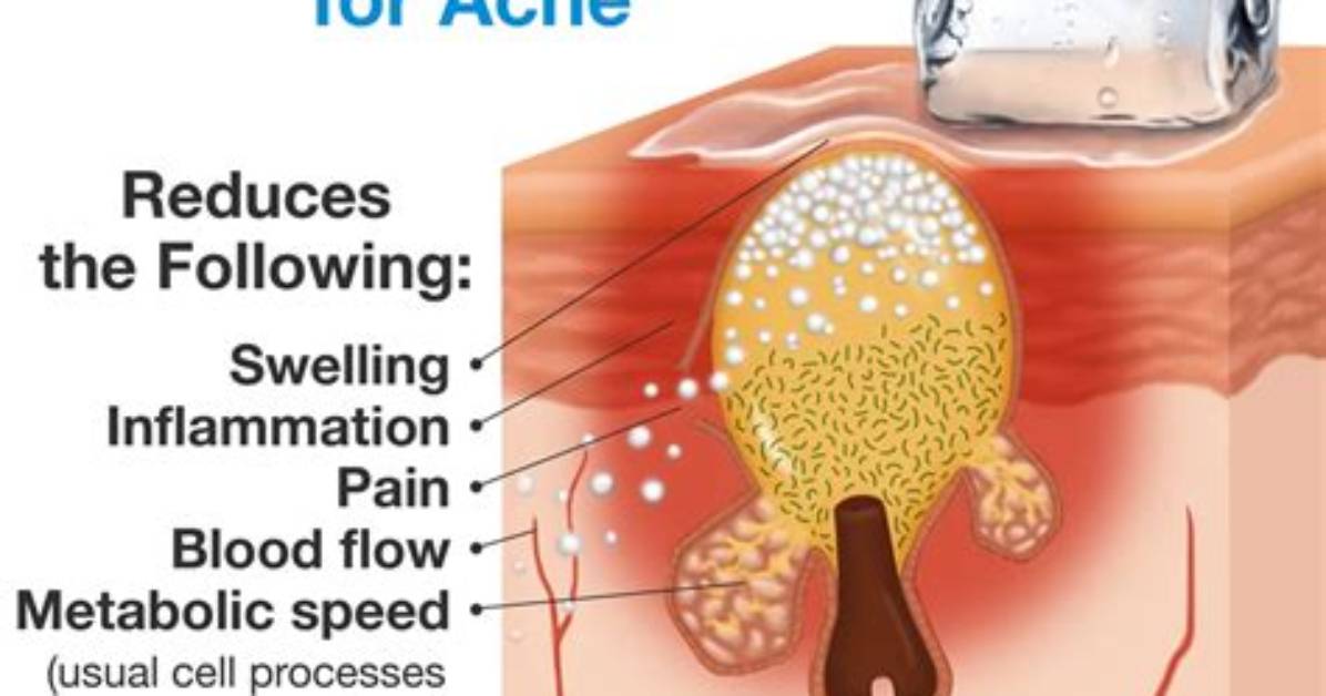 Does Icing a Blind Pimple Help?