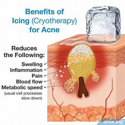 Does Icing a Blind Pimple Help?