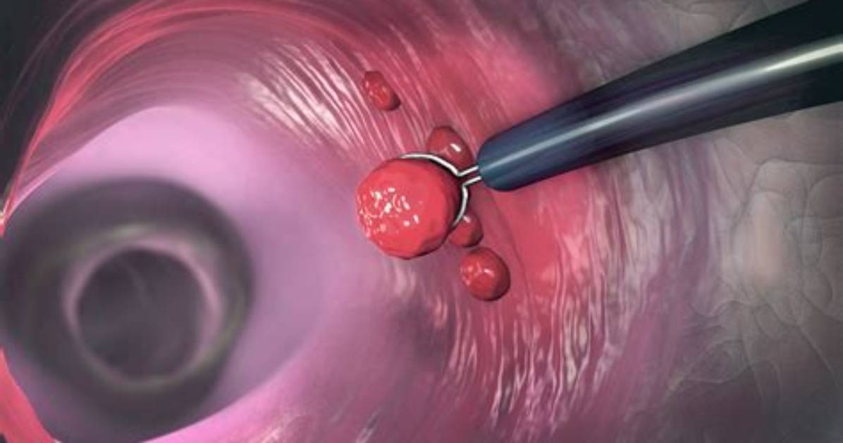 Does It Hurt After Polyps Are Removed?