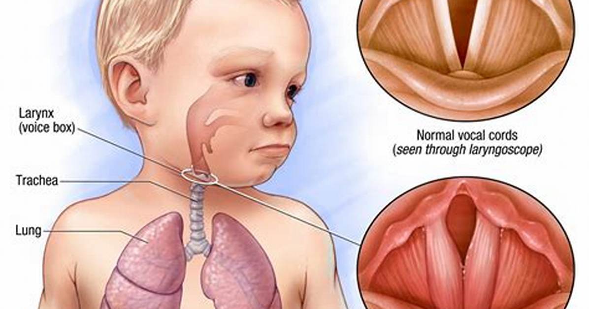 Does Laryngitis Go Away?