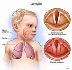 Does Laryngitis Go Away?