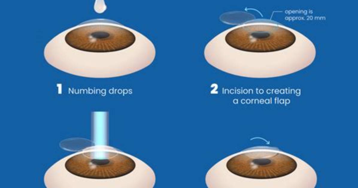 Does Lasik Fix