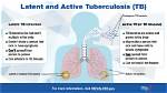 Does Latent Tb Go Away by Itself?