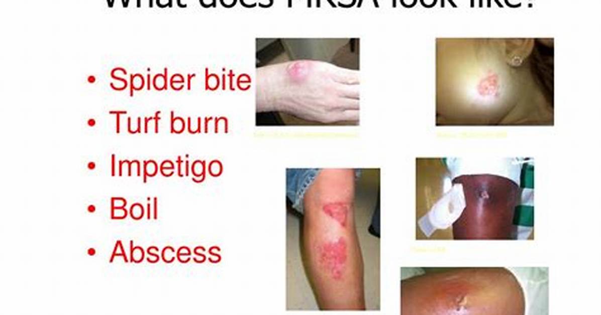 Does Mrsa Look Like Bug Bites?