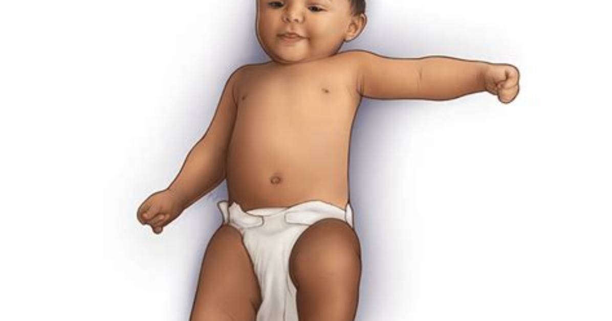 Does My Baby Have Clubfoot?