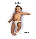 Does My Baby Have Clubfoot?