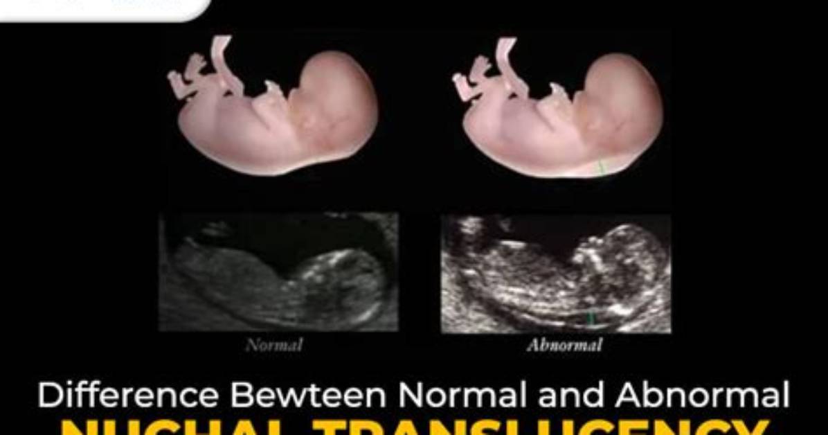 Does Nuchal Translucency Test Hurt?