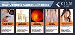 Does Ozempic Cause Diabetic Retinopathy?