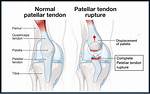 Does Patellar Tendon Grow Back?