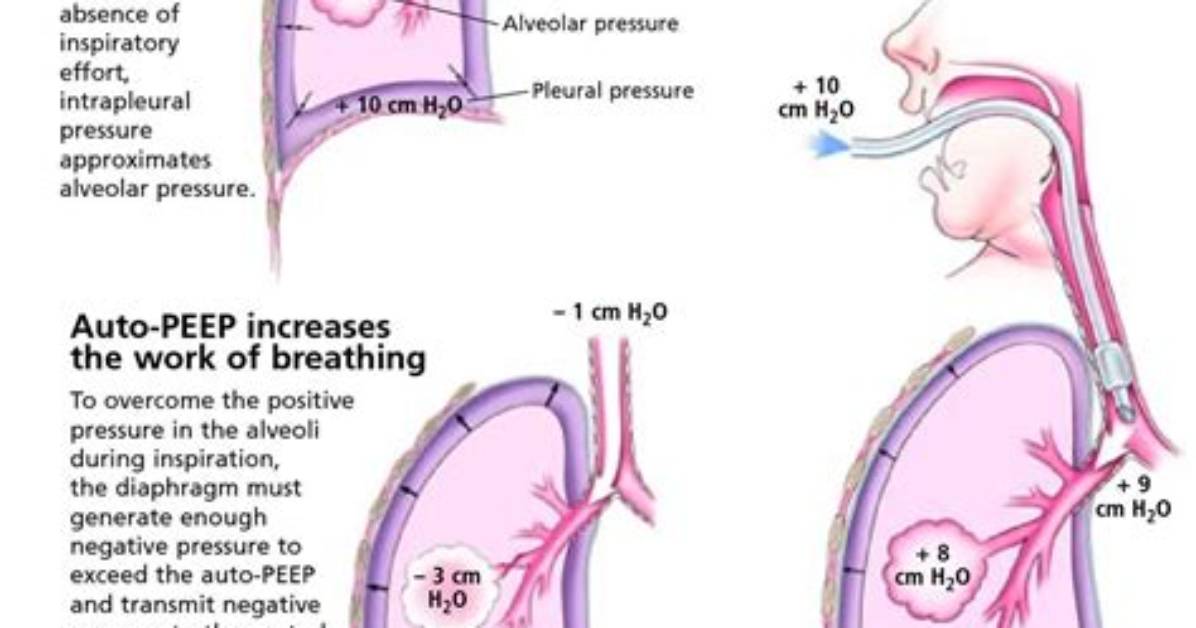 Does Peep Increase Blood Pressure?