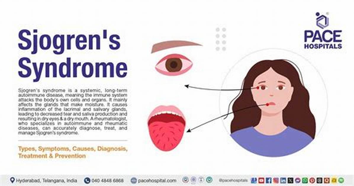Does Prednisone Help Sjogren's Syndrome?