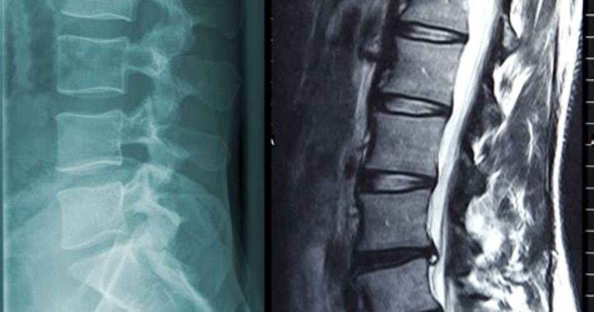 Does Sciatica Always Show up on Mri?