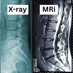 Does Sciatica Always Show up on Mri?