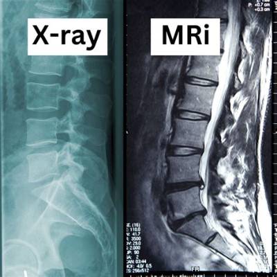 Does Sciatica Always Show up on Mri?