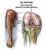Does Tearing an Acl Graft Hurt?