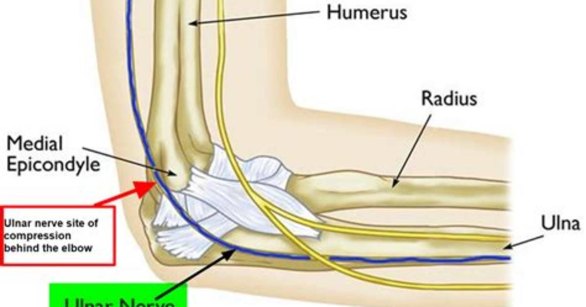 Does Tennis Elbow Affect the Ulnar Nerve?