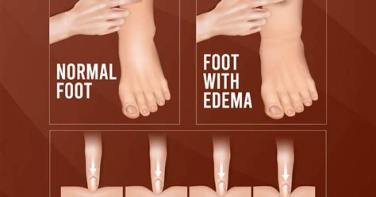 Does Walking Make Edema Worse?