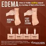Does Walking Make Edema Worse?