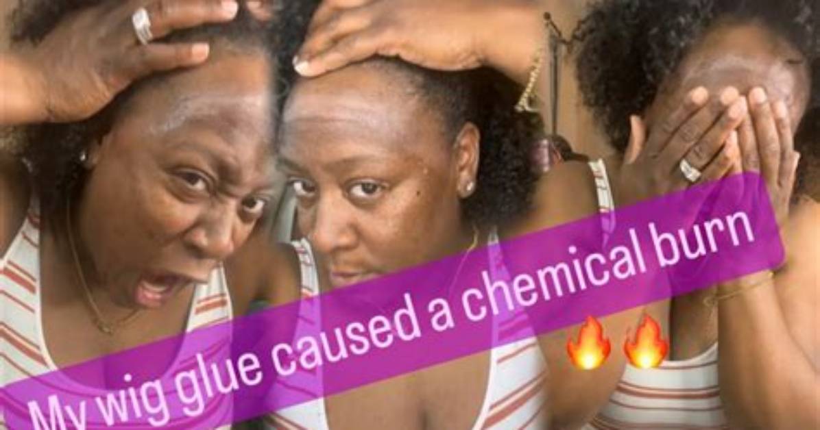 Does Wig Glue Damage Your Skin?