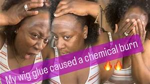 Does Wig Glue Damage Your Skin?