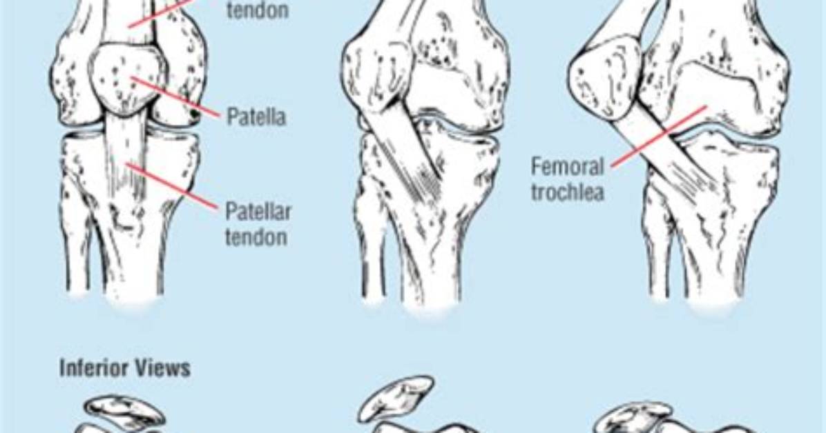 During Most Patellar Subluxations the Patella Moves?