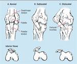 During Most Patellar Subluxations the Patella Moves?