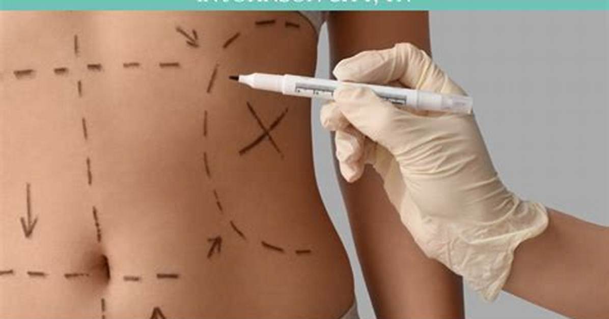 Expert Liposuction by Peter: Transform Your Body Today