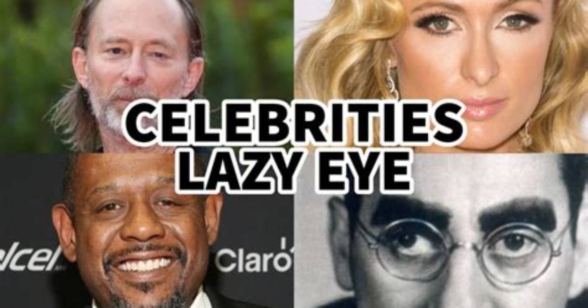 Eye Catching Celebrities with Lazy Eye