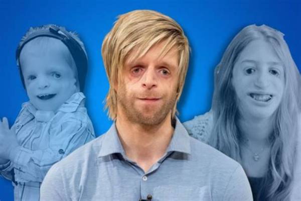 Famous Actors Impacted by Treacher Collins Syndrome