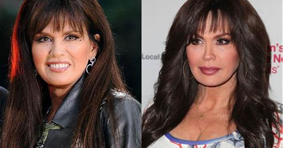 Has Marie Osmond Done Facelift and Plastic Surgery? Before and After Pics, Age and Height