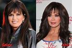 Has Marie Osmond Done Facelift and Plastic Surgery? Before and After Pics, Age and Height