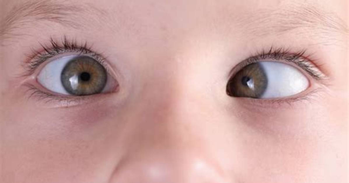 Has My Baby Got a Squint?