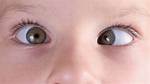 Has My Baby Got a Squint?