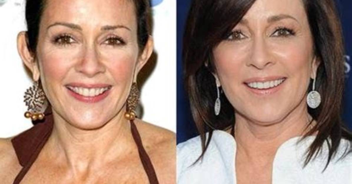 Has Patricia Heaton Had Plastic Surgery Findings and Expert