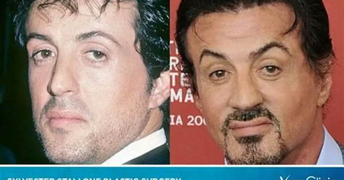 Has Sylvester Stallone Had a Stroke? Exploring the Facts and Myths