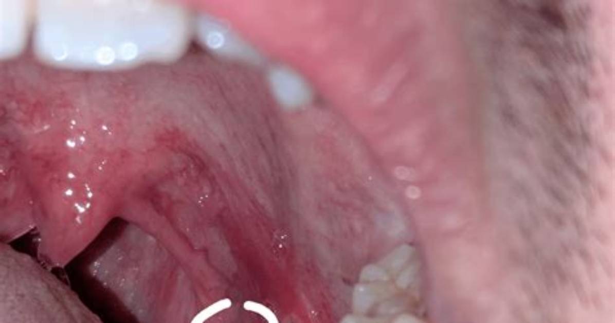 Has Ulcer on Tonsil?