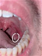Has Ulcer on Tonsil?