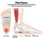 Heal Hypertrophic Spurs: Causes, Symptoms, and Treatments