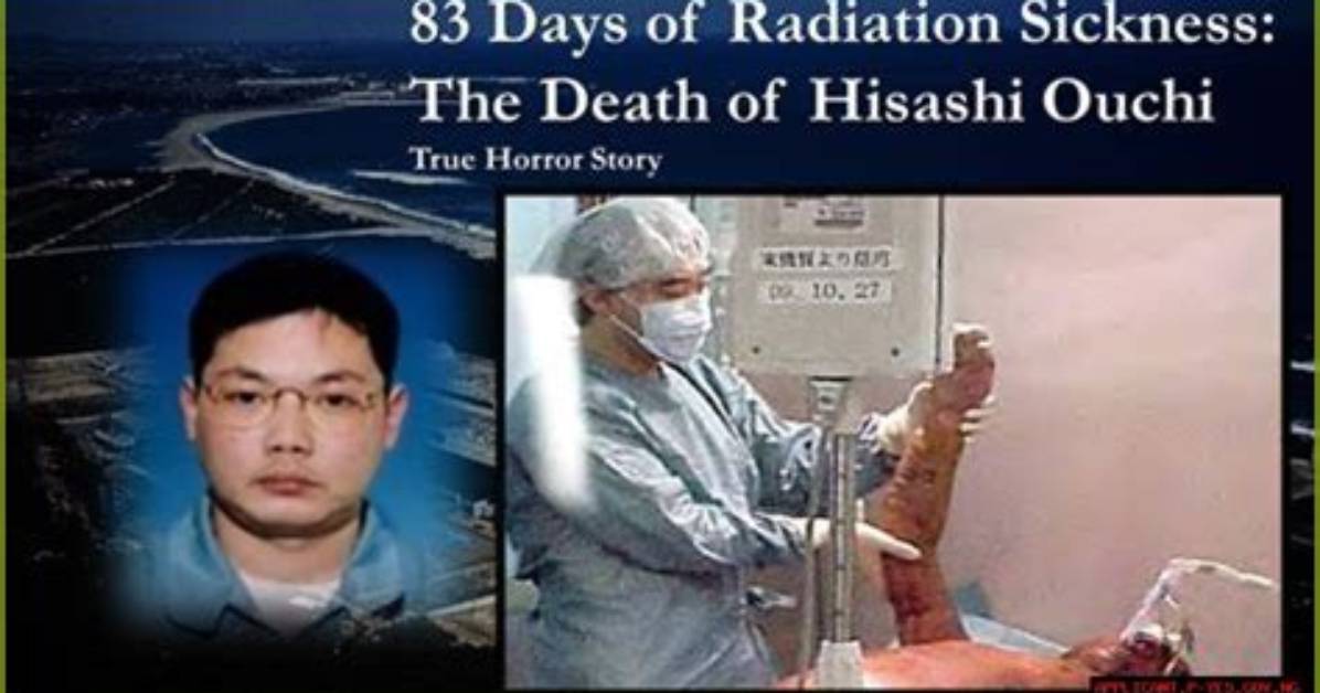 Hisashi Ouchi: a Tragic Tale of Nuclear Radiation's Devastating Effects