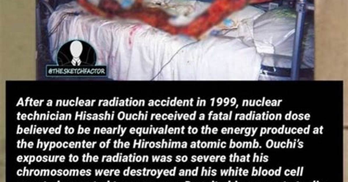 Hisashi Ouchi: the Horrific Reality of Radiation Exposure - True Photos Revealed